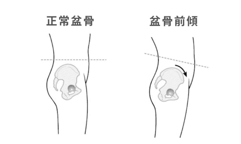 盆骨前傾