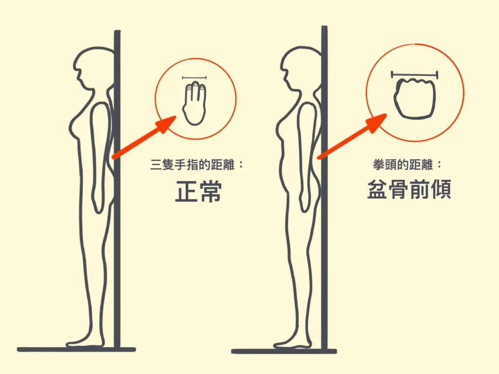 盆骨前傾測試